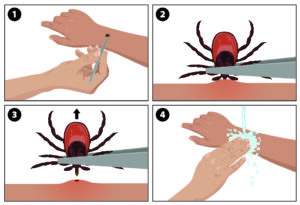A cartoon showing how to remove a tick. Grasp the tick near its head, then pull firmly and steadily away from the skin. Afterwards, wash the wound with soap and hot water.